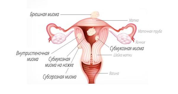 Миома матки